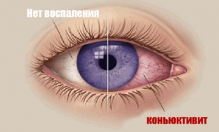 kon-yunktivit-chto-neobkhodimo-znat-o-prirode-etogo- заболеванія