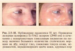 korrektsiya-involyutsionno-distroficheskikh-izmenenij-kozhi-metodom-lazerno >
<p><strong>Рубцювання внаслідок перенесеної вугрової хвороби.</strong> <br /><br />Лазерне шліфування може суттєво покращити стан шкіри, ураженої вугровим рубцюванням. У ході процедури дуже акуратно обробляються краї рубцевої тканини, де необхідно випарувати більший об'єм тканини, а інші ділянки піддаються лише поверхневому шліфуванню. <br /><br />Скорочення шкіри внаслідок впливу СО2 лазера може дати дуже хороші результати при обробці м'яких атрофічних рубців із похилими краями. <br /><br />Короткоімпульсний Er:YAG лазер дозволяє досягти слабкого та помірного покращення з мінімальним ризиком побічних ефектів. Глибокі рубці краще піддаються лікуванню за допомогою СО2 та довгоімпульсних Er:YAG лазерів (рис. 2.5-19). <br /><br /> Для досягнення максимального результату потрібно кілька процедур, а на найбільш складних ділянках можуть знадобитися додаткові методи лікування: відлущування, висічення, наповнювачі, імплантати.<br /><br /><strong>Пігментації.</strong> <br /><br />Пістозапальна гіперпігментація та мелазма можуть видалятися одночасно з корекцією інших вікових змін, при цьому важливе щоденне застосування сонцезахисного крему, а також третиноїну та гідрохінону протягом тривалого періоду до та після лазерної терапії. <br /><br />Мелазма, в силу своїх етіопатогенетичних особливостей, має тенденцію до рецидивування після обробки, тому її шліфування має передувати корекція гормонального фону. <br /><br /> Поверхнева та глибока дермальна пігментація та диспігментація добре піддаються обробці короткоімпульсним Er:YAGлазером, також ефективним і при підготовці ділянки реципієнта для пересадки епідермісу у разі вітіліго. <br /><br />Для боротьби з надмірною пігментацією без супутнього шліфування ефективніші імпульсні лазери, основним хромофором яких є меланін (600-900 нм), т.к. вони не вимагають серйозної анестезії і після їх використання загоєння протікає швидше. Актинічний хейліт. за яким слідує обробка стійких ділянок. Особливо ефективна обробка уражень, що локалізуються на тильній стороні рук та волосистої частини голови. Загоєння займає до 10 днів.<br /><br /><strong>Посттравматичні та хірургічні рубці.</strong> <br /><br />Шліфування Er:YAG лазером на етапі реконструкції колагену (перші 90 днів після травми) може істотно поліпшити косметичний вигляд посттравматичних, так і хірургічних рубців. Найбільш ефективно піддаються лікуванню лінійні рубці. <br />Великі атрофічні рубці добре обробляються СО2 лазером завдяки сильному позитивному ефекту скорочення колагену.</p> Найбільш ефективно піддаються лікуванню лінійні рубці. <br />Великі атрофічні рубці добре обробляються СО2 лазером завдяки сильному позитивному ефекту скорочення колагену.</p> Найбільш ефективно піддаються лікуванню лінійні рубці. <br />Великі атрофічні рубці добре обробляються СО2 лазером завдяки сильному позитивному ефекту скорочення колагену.</p>
<div class=