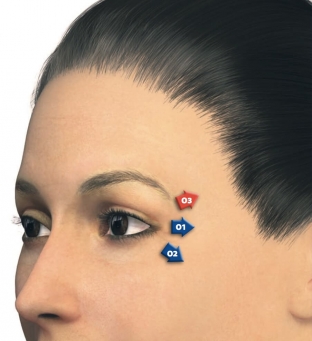 korrektsiya-morshchin-periorbitalnoj-oblasti-effektivny-preparat-juv-derm /></p>
<h2>Процедура корекції зморшок періорбітальної області з препаратом Juvéderm® VOLBELLA<sup>TM</sup></h2>
<p>Існують певні особливості ін'єкційного введення препарату Juvéderm® VOLBELLA<sup>TM</sup> with Lidocaine від <a href=