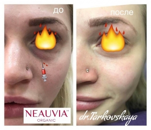 korrektsiya-periorbitalnoj-zony-litsa-fillerami-kak-vybrat-effektivnyj-prepara ></p>
<div class=