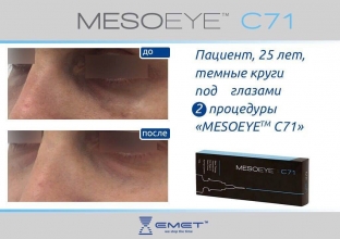 korrektsiya-temnykh-krugov-i-otechnosti-mekhanizm-dejstviya rezultaty-primeneniya-preparata-mesoeye