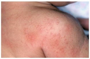 krapivnitsa-posle-stressa-mekhanizm-razvitiya-i-metody-lecheniya