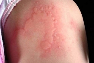 krapivnitsa-posle-stressa-mekhanizm-razvitiya-i-metody-lecheniya