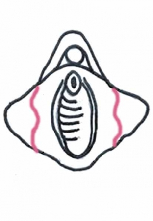 labioplastika-znachitelno-uluchshaet-seksualnuyu-zhizn-patsientok