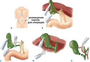 laparoskopichekaya-kholetsistektomiya-pomozhet-vylechit-zhelchnokamennuyu-p>
<div class=