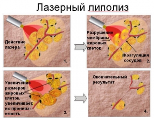 lazernaya-liposaktsiya-populyrnaya-novinka-v-borbe-s-zhirom