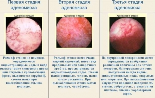 lechenie-adenomioza-vozmozhnye-riski-i-prognozy