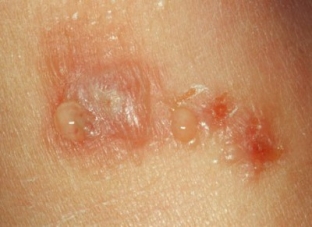 lishaj-na-litse-rasprostranennye-vidy-i-kharakternye-simptomy
