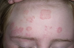 lishaj-na-litse-rasprostranennye-vidy-i-kharakternye-simptomy