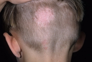 lishaj-na-litse-rasprostranennye-vidy-i-kharakternye-simptomy