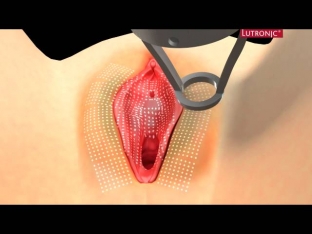 lutronic-action-ii-petit-lady-lazer-dlya-vaginalnogo-omolozheniya 