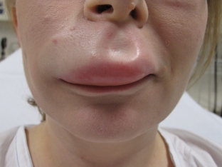 mekhanizm-razvitiya-i-osnovnye-simptomy-angiooteka