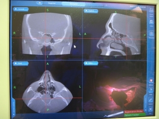mukotsele-lobnoj-pazukhi-kak-vovremya-vyyavit-bolezn