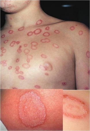 na-chto-pokhozh-strigushchij-lishaj-kak-ne-oshibitsya- v-diagnostike