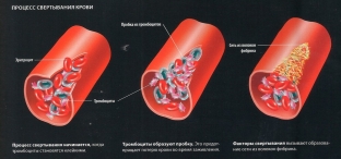 narushenie-svertyvaemosti-krovi-kak-vyyavit-i-nejtralizovat-opasnuyu-patology ></p>
<div class=