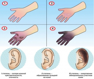 neotlozhnaya-pomoshch-pri-obmorozhenii-simptomy-opredelyayut-takti> </p>
<h2>Невідкладні заходи під час обмороження: як надати допомогу</h2>
<p>Невідкладна допомога при обмороженні полягає у відновленні нормальної температури тканин, боротьбі з шоковими проявами та гіпоксією тканин. Насамперед, необхідно запам'ятати, що розтирання ураженої ділянки снігом та прийом алкоголю в період обмороження категорично протипоказано! Пацієнта необхідно внести тепле приміщення та роздягнути. Уражена ділянка обробляється спиртом або антисептиком з метою запобігання потраплянню мікроорганізмів у рану та розвитку бактеріального процесу. Потім уражена область насухо витирається і на неї накладається пов'язка, що теплоізолює, далі теплою тканиною закривають всю кінцівку. Якщо після зігрівання больовий синдром зменшується – це говорить про легке обмороження, яке не вимагає надання допомоги в умовах стаціонару. Якщо ж больовий синдром не минає, а уражена ділянка залишається блідою і холодною. обмороження найімовірніше 3-4 стадії, і пацієнта необхідно госпіталізувати.</p>


                        


                                            </div>
                                        <div id=