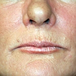 novinka-filler-belotero-belotero-protiv-morshchin