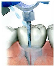 novye-apparaty-dlya-chistki-zubov-preimushchestva-ultrazvukovoj-chistki- zubov