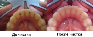 novye-apparaty-dlya-chistki-zubov-preimushchestva-ultrazvukovoj-chistki- zubov