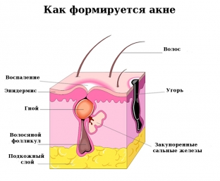 o-chem-svidetelstvuet-problema-akne-na-shchekakh-lbu- nosu-i-podborodke