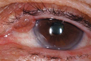 opasnost-melanomy-vek-kharakternye-simptomy-i-effektivnoe-lechenie-opukholi