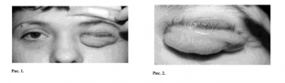 operatsiya-blefaroplastika-pri-nejrofibromatoze-kak-poluchit-krasivý-stojkij-rezul /></p>
<p>Друга та третя пацієнтки раніше вже оперувалися в інших профільних лікувальних закладах.</p>
<div class=