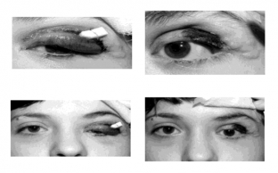 operatsiya-blefaroplastika-pri-nejrofibromatoze-kak-poluchit-krasivyj-stojkij-rezultat /></p>
<p>Функціональні та косметичні результати проведеної операції блефаропластики були оцінені у першої та другої пацієнток як хороші, у третьої пацієнтки – ndash; як задовільні. Протягом 1-2 років усі три прооперовані пацієнтки відзначали стійку ремісію.</p>
<blockquote>
<p>В результаті операції блефаропластики вдалося усунути деформацію століття при нейрофіброматозі та відновити його функції.</p>
</blockquote>
<p> </p>


                        

                        

                        <div id=