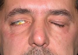 oslozhneniya-blefaroplastiki-prichiny-i-metody-profilaktiki