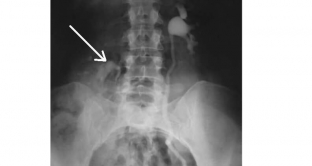 oslozhneniya-nefroptoza-kakie-metody-pomogut-ikh-izbezhat
