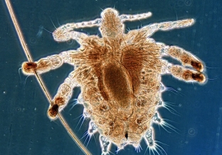 oslozhneniya-pedikuleza-mogut-li-byt-opasnymi-ukusy-vshej