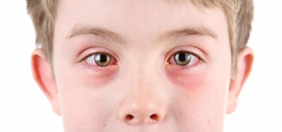 osnovnye-formy-i-simptomy-allergichesko-kon-yunktivita