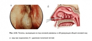 osobennosti-lecheniya-khronicheskogo-etmoidita-o-chem-vazhno-znat