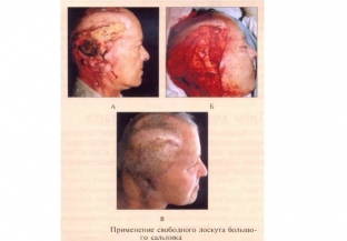 osobennosti-primenenia-loskutov-iz-myshechnoj-tkani-i-bolshogo-salnika