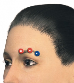 osobennosti-protsedury-modelirovania-brovej-s-preparatom-juv-derm-volift-tm