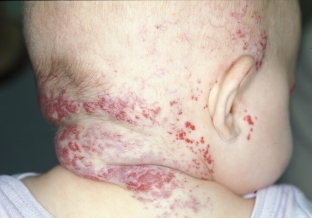 osobennosti-proyavleniya-i-diagnostiki-gemangiomy-kozhi