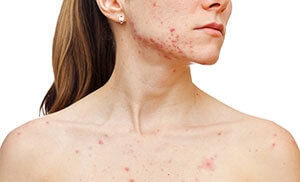 osobennosti-simptomov-i-lecheniya-parazitarnykh-dermatozov