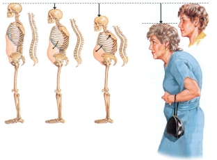 osteoporoz-opasnaya-bolezn-stareyushchikh-kostej