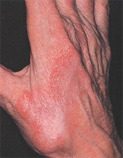 pochemu-dermatit-kistej-meshaet-sotsialnoj-zhizni-patsienta