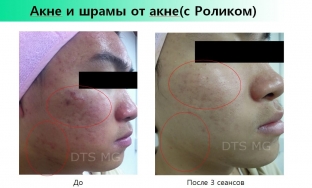 polipeptidy-protiv-stareniya-kozhi-za-schet-chego-effektivna-kosmetsevtika- genosys