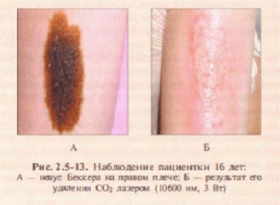 porazheniya-melanogennoj-sistemy-i-ikh-lechenie-lazerom