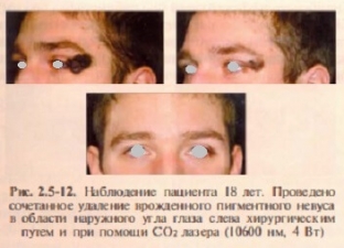 porazheniya-melanogennoj-sistemy-i-ikh-lechenie-lazerom