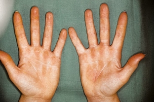 prichiny-i-kharakternye-simptomy-allergii-na-metall