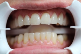 prichiny-i-klinicheskie-proyavleniya-patologicheskoj-stiraemosti-zubov