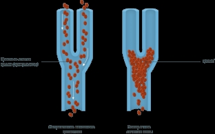 prichiny-i-simptomy-tromboza-sovremennoe-lechenie-tromboza-glub ven