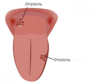 prostoj-nalet-ili-rak-skrytye-simptomy-raka- yazyka