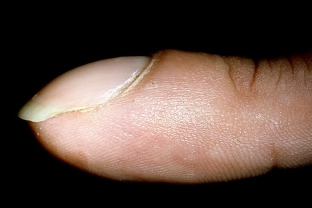 raznovidnosti-i-osnovnye-prichiny-onikhodistrofij