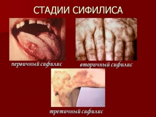 sifilis-neredko-diagnostiruyut-pri-sluchajnom-medosmotre