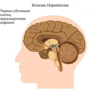 stala-izvestna-prichina-vozniknoveniya-bolezni-parkinsona