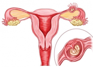 svoevremennaya-diagnostika-vnematochnoj-beremennosti-pomozhet-predotvratit-katastro
                        ></p>
<h2>Діагностика позаматкової вагітності: трубний аборт</h2>
<p>Діагностика трубного аборту також є складною і ґрунтується на таких даних:</p>
<ul>
<li>особливості анамнезу: затримка менструації може становити від кількох днів до 2-3 місяців;</li>
<li>клінічна картина: приступоподібні болі, що збігаються за часом із кровотечею зі статевих шляхів, що нагадує «кавову гущу»;</li>
<li>піхвове дослідження: пальпується незначне розм'якшення та збільшення тіла матки, болючість і пастозність придатків матки, напруга заднього склепіння піхви;</li>
<li>загальний аналіз крові: зниження рівня гемоглобіну, гіпохромна анемія, зсув лейкоцитарної формули вліво;</li>
<li>у крові визначається хоріонічний гонадотропін;</li>
<li>ультразвукове дослідження допомагає уточнити діагноз трубного аборту.</li>
</ul>
<h2>Методи діагностики розриву маткової труби</h2>
<p>Розрив маткової труби діагностувати досить легко, оскільки клінічна картина захворювання досить характерна. Больовий синдром у таких пацієнток виникає різко на тлі повного благополуччя, біль має характерну іррадіацію, часто виникають тенезми та рідке випорожнення. У пацієнток відзначається блідість шкіри та слизових оболонок, холодний піт та задишка, вони загальмовані та апатичні. Характерним є значне зниження артеріального тиску: тиск систоли може бути нижче 80 мм.рт.ст. Пальпаторно визначається різка болючість живота, симптоми подразнення очеревини, нависання та болючість заднього склепіння піхви. Лапароскопічне дослідження допомагає не лише уточнити діагноз, а й визначити схему лікування пацієнтки.</p>


                        

                        

                        <div id=