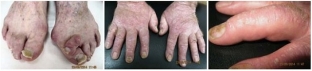 svoevremennoe-lechenie-artropaticheskogo-psoriaza-snizhaet-tempy-progressi >
<p>При обстеженні: прискорена ШОЕ (38 мм/год), інші показники клінічного аналізу крові в межах фізіологічної норми; в біохімічному аналізі крові виявлено підвищення рівня лужної фосфатази (3614 нмоль/с), С-реактивний білок позитивний, підвищені рівні показників сполучнотканинного обміну (серомукоїди – 6,3 од. SH, сіалові кислоти – 0,2; глікопроте- іди – 0,59 у. е.).</p>
<p>При рентгенологічному обстеженні: визначаються ознаки двостороннього вираженого сакроілеїту з частковим анкілозуванням; гомілковостопних суглобів у бічній проекції – визначаються ознаки ахіллобурситу та підошовного бурситу з двох сторін з утворенням “п'яткових шпор“ по підошовних поверхонь кісток п'яти, резорбція шийок таранних кісток, крайова резорбція головок V плюсневых кісток; стоп у прямій проекції – визначається крайова деформація головок плюсневих кісток, особливо V праворуч, ознаки артрозу у плюснефалангових суглобах з підвивихом пальців, екзостози на підставі дистальних фаланг І пальця, підвивих ІІ пальця зліва у плюснефалангових суглобах; кистей у прямій проекції – визначаються ранні ознаки артрозу в міжфалангових та п'ястково-фалангових суглобах,
<p>Встановлено діагноз: 